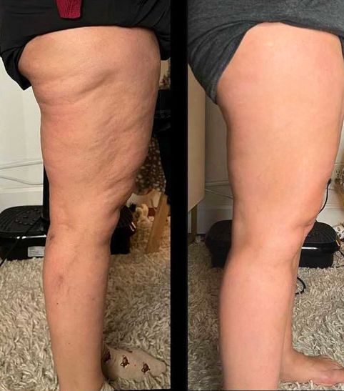 LOTO LIMPIA TU SISTEMA LINFATICO