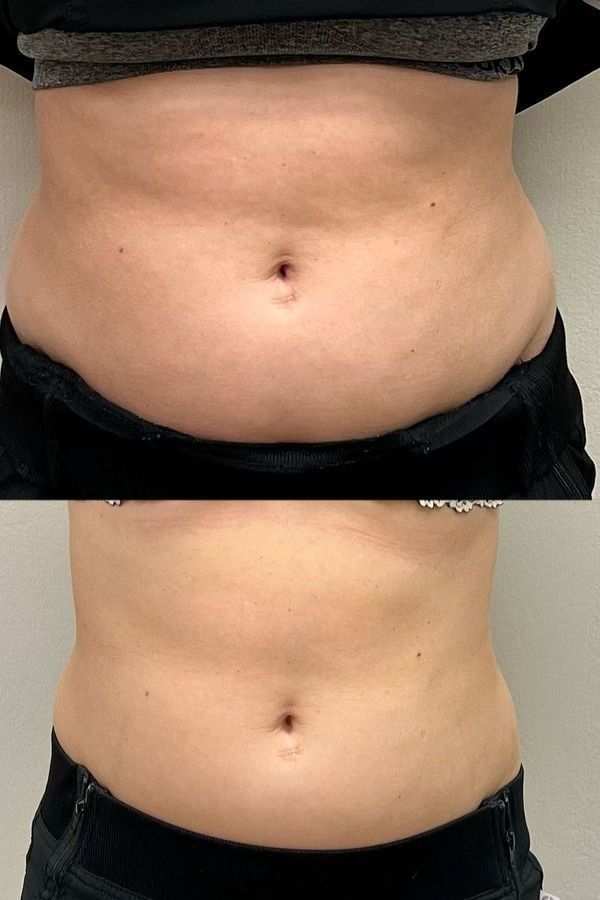 LOTO LIMPIA TU SISTEMA LINFATICO